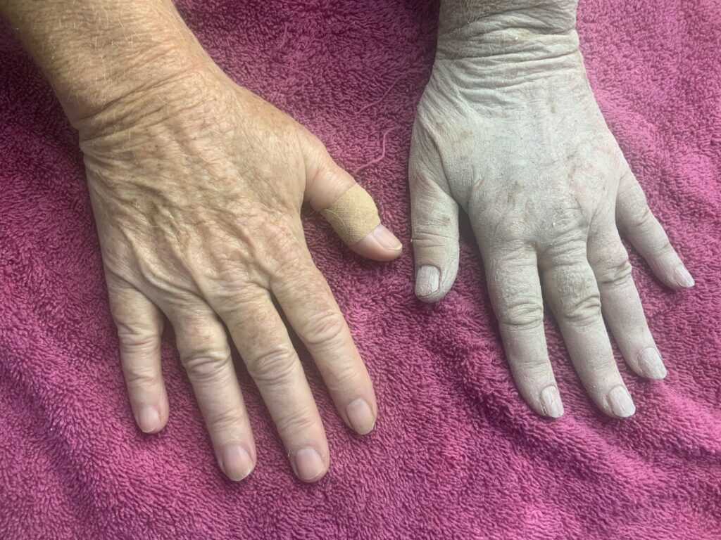 Hands - Before/After